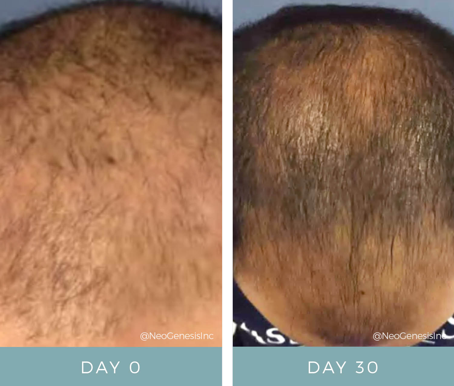 Hair Loss - Before + After Hair Thickening Serum