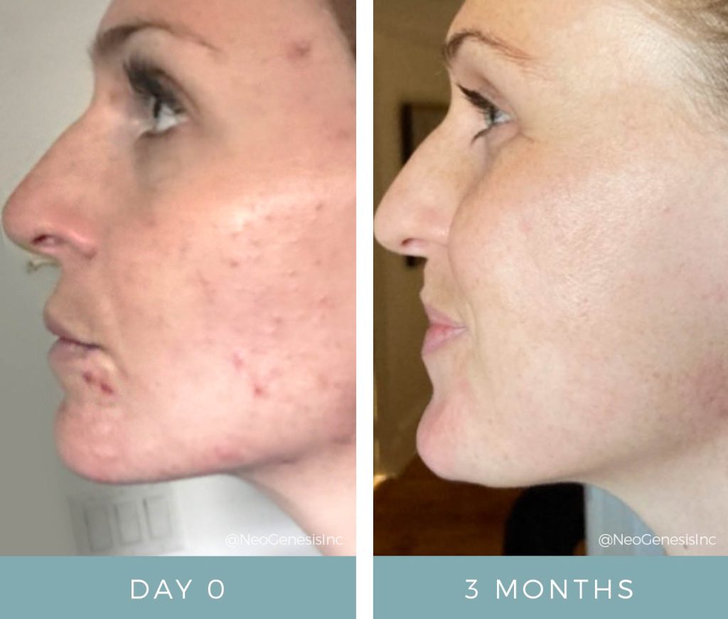 Hormonal Acne - Before + After Results