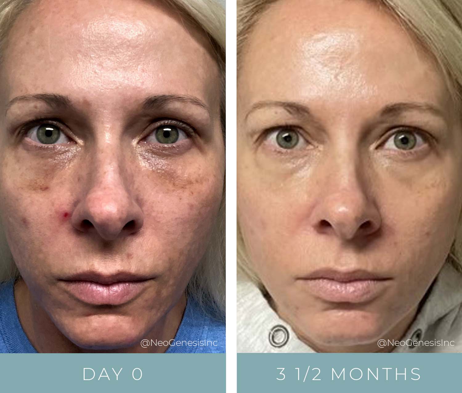 Melasma - Before + After NeoGenesis Skin Care Products