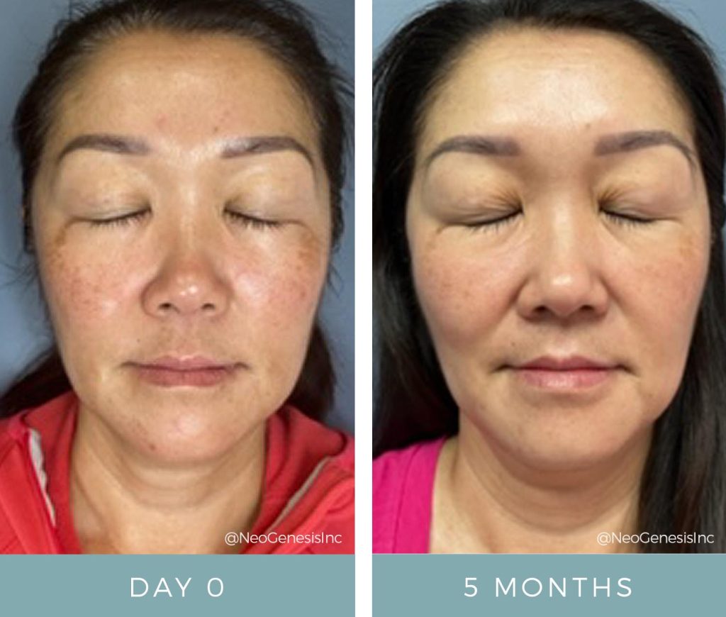 Melasma + Sun Damage + PIH - Before and After NeoGenesis Skincare Products