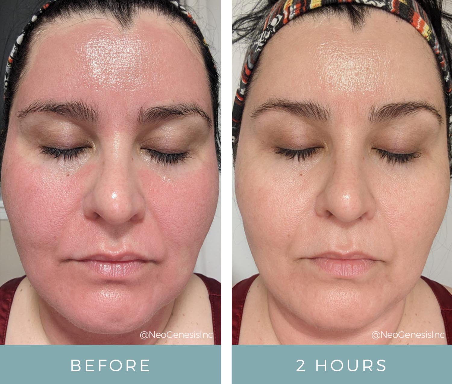 Microneedling + NeoGenesis Skincare Products - Before + After