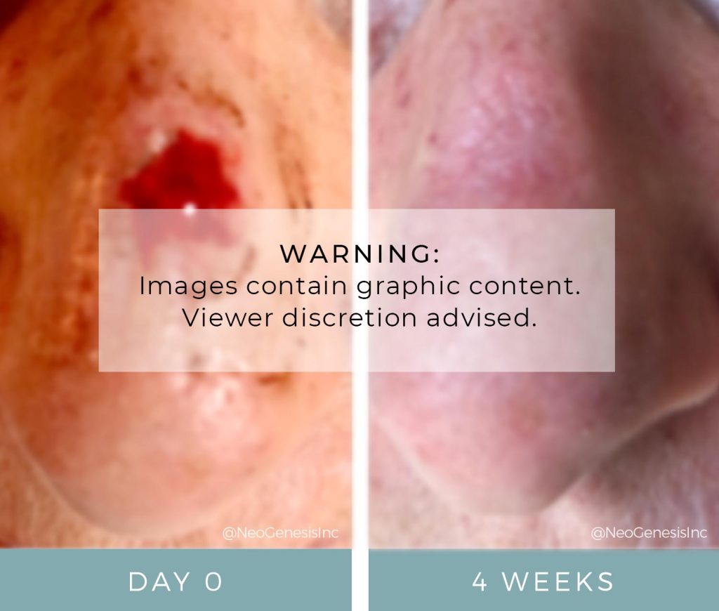 Mohs Surgery Before + After NeoGenesis Oncology Friendly Skincare Products