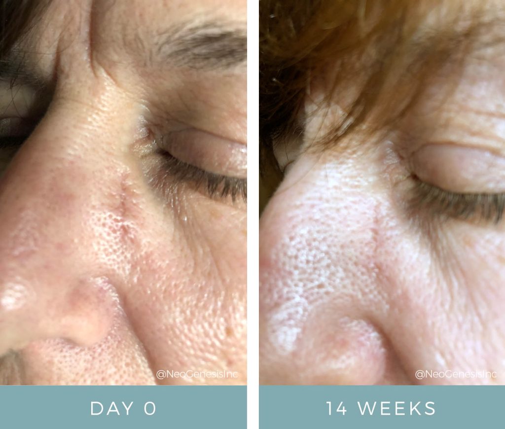 Mohs Surgery - Before + After NeoGenesis Recovery Serum
