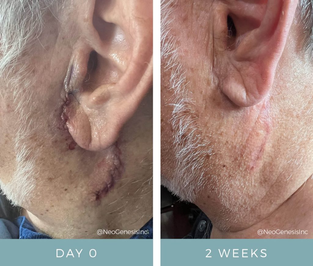 Cancer Surgery Scarring - Before + After