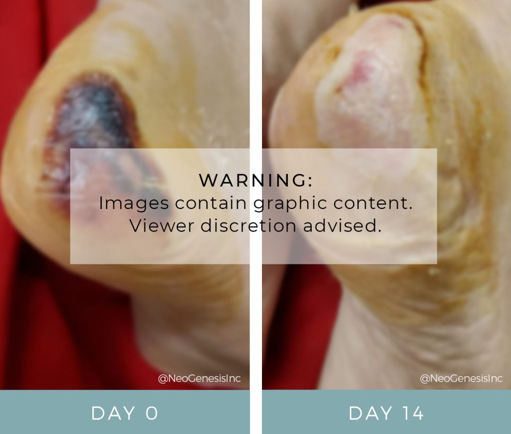 Pressure Ulcers - Before + After NeoGenesis Recovery Serum