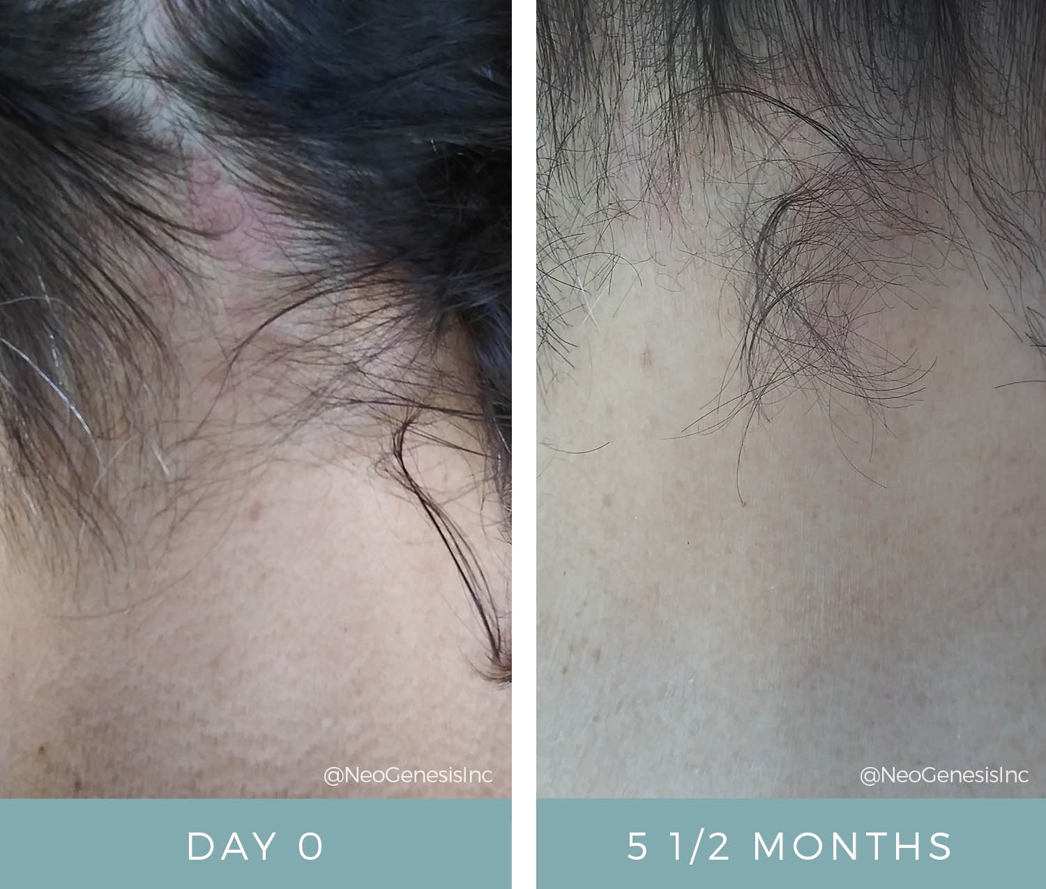 Psoriasis - Before + After NeoGenesis Skin Care Products