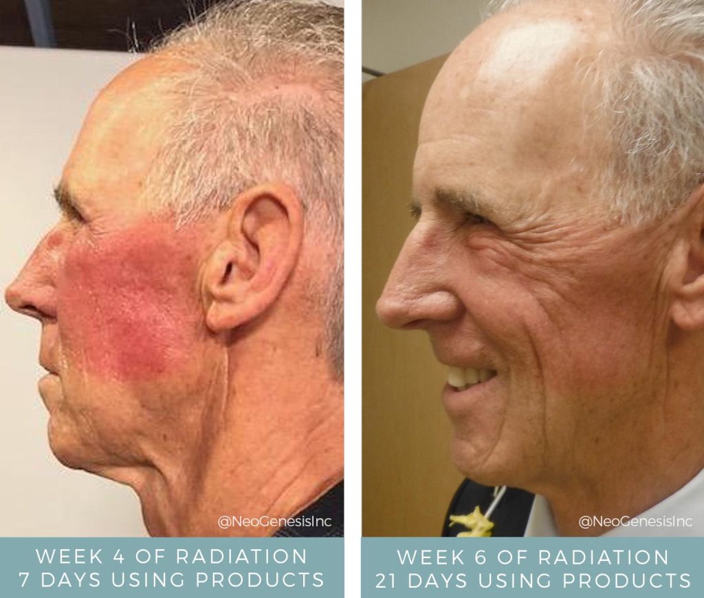 Before + After - Radiation Dermatitis