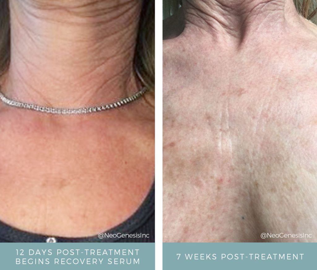 Radiation Treatment and Lupus - Before + After