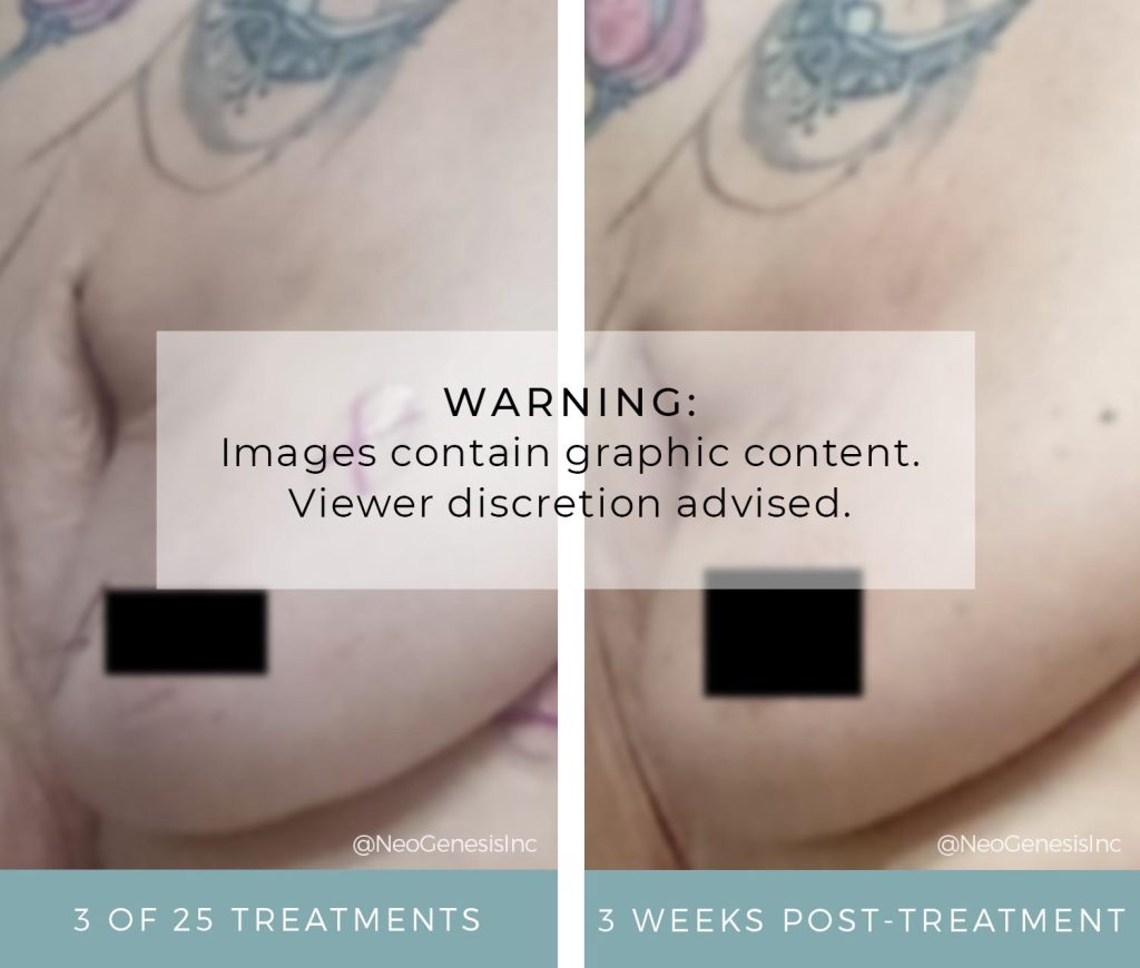 Radiation Side Effects - Breast Cancer - Before + After Photos