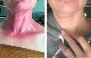 Before + After - Radiation Burns Tongue Cancer