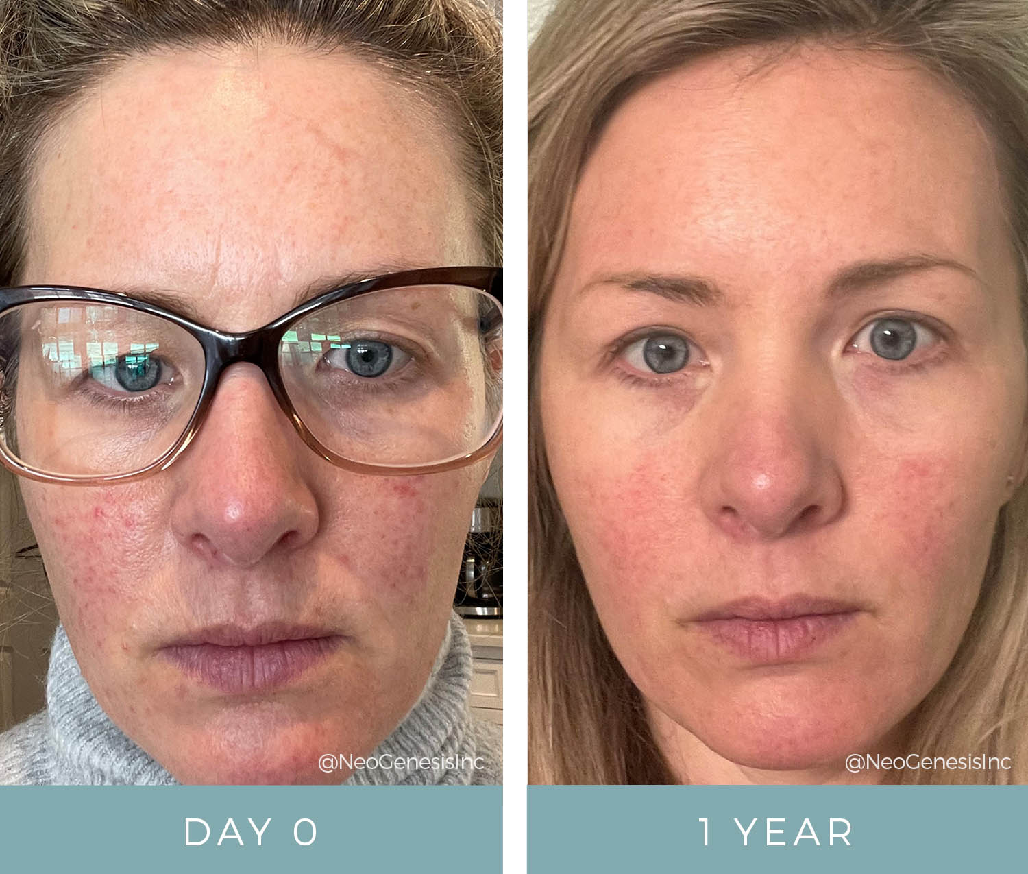 Rosacea - Before + After Testimonial