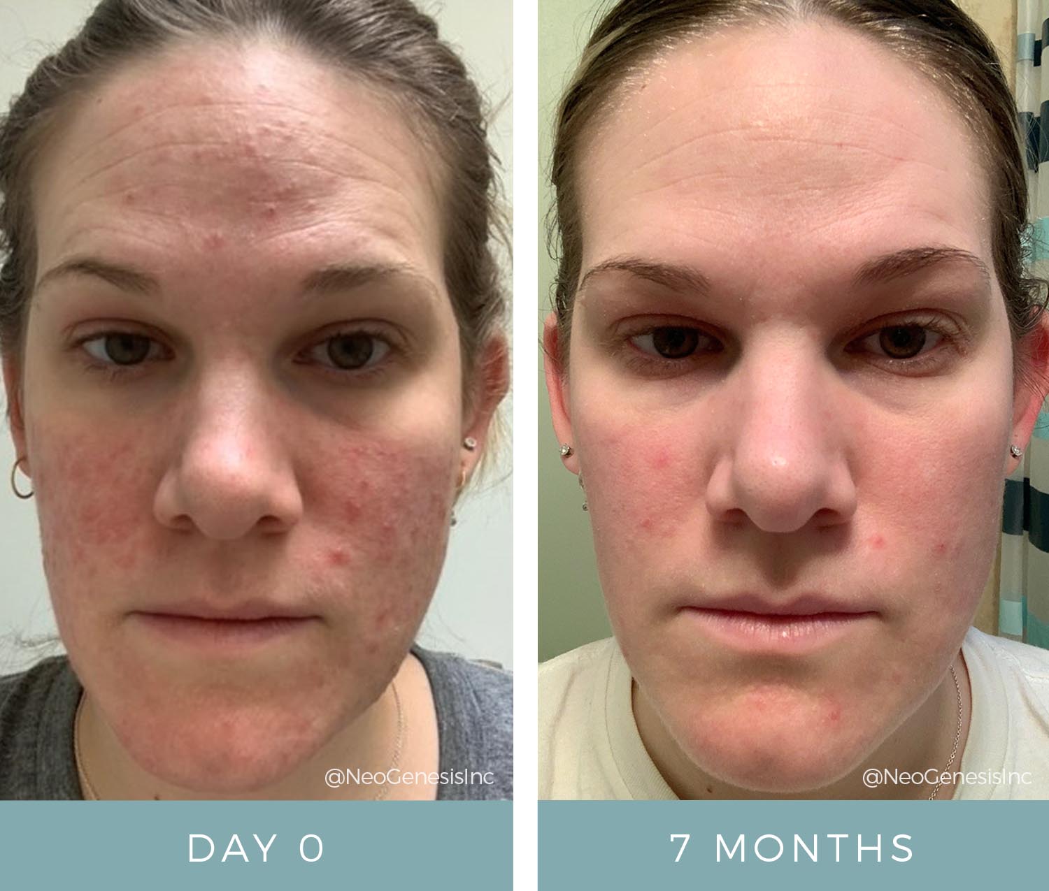 Rosacea - Before + After NeoGenesis Skin Care Products