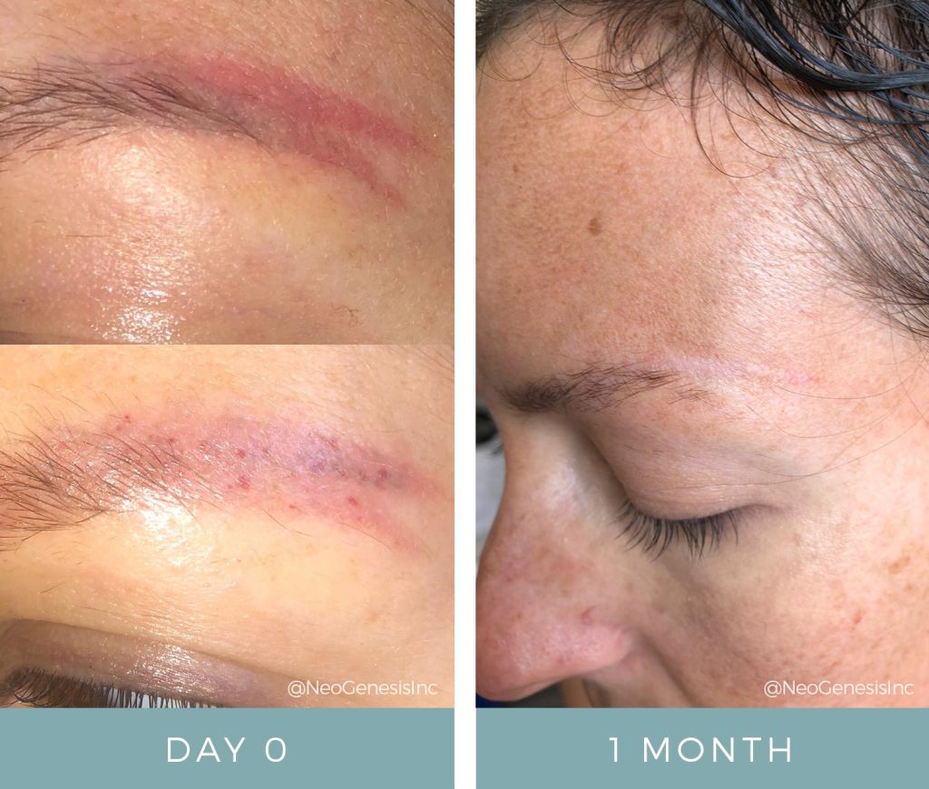 Scarring - Micropigmentation brows