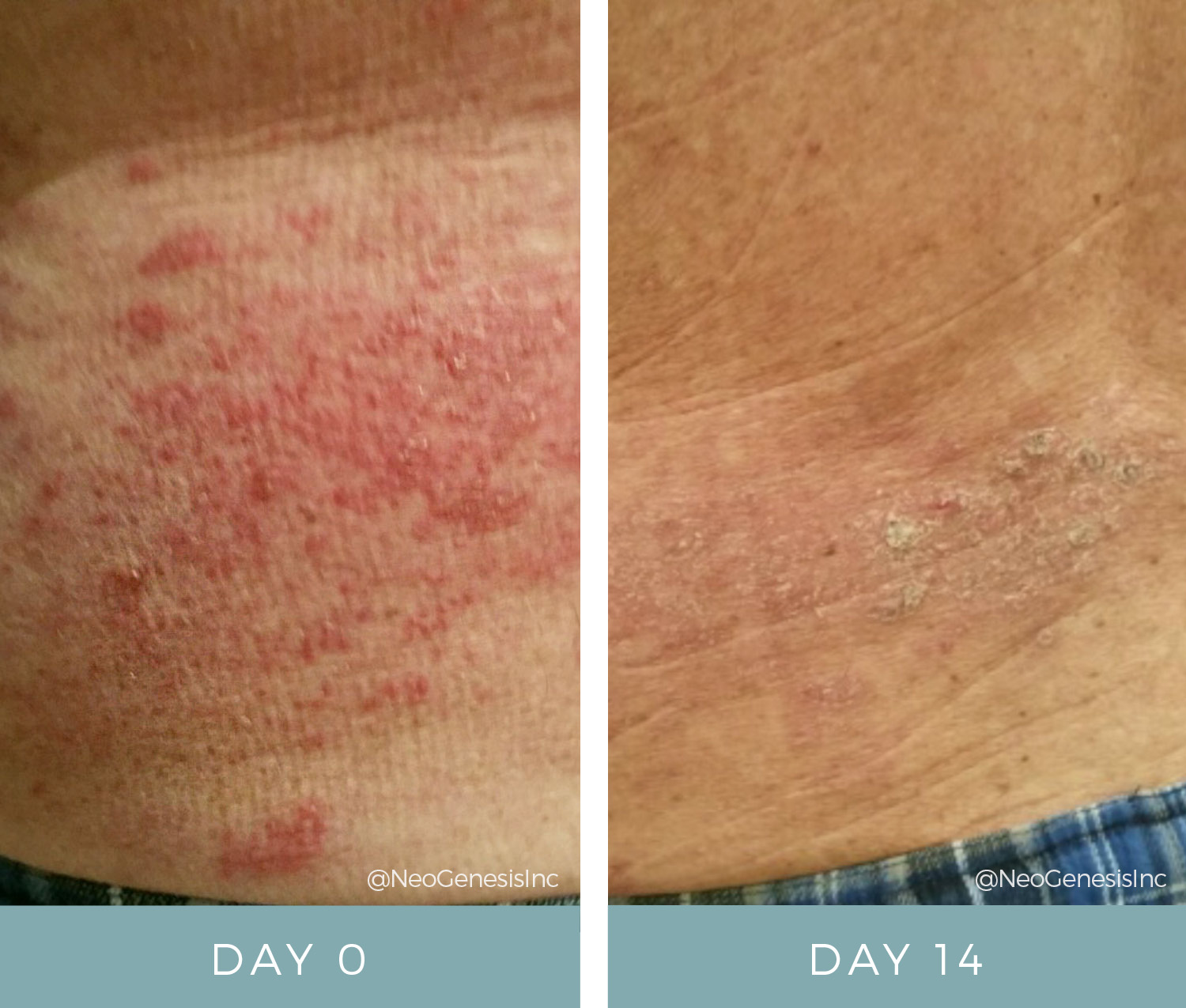 Shingles - Before + After NeoGenesis Recovery Serum