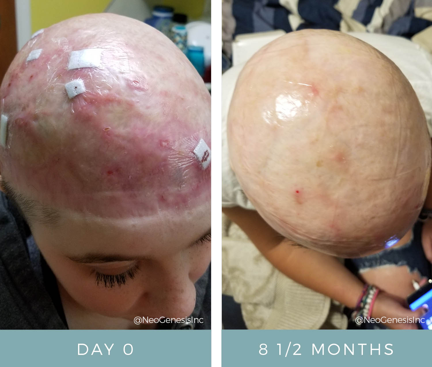 Wound Care for Scalp Injury - Before + After