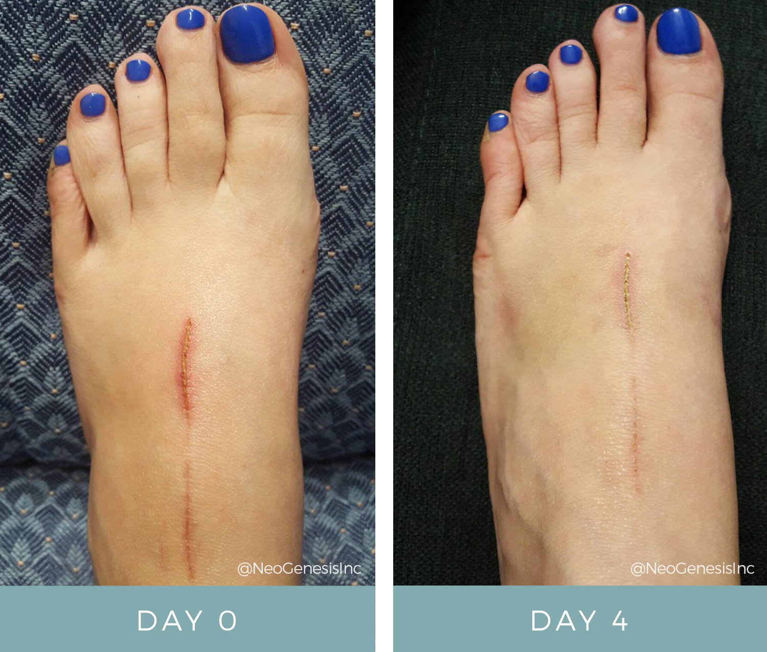 Wound Care + Scarring - Before + After