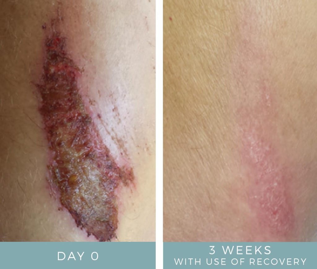 Wound Care for Bike Accident - Before + After