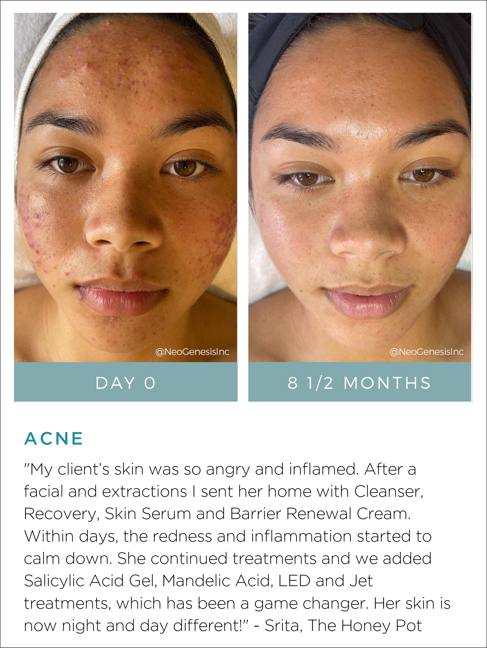 Acne Before + After