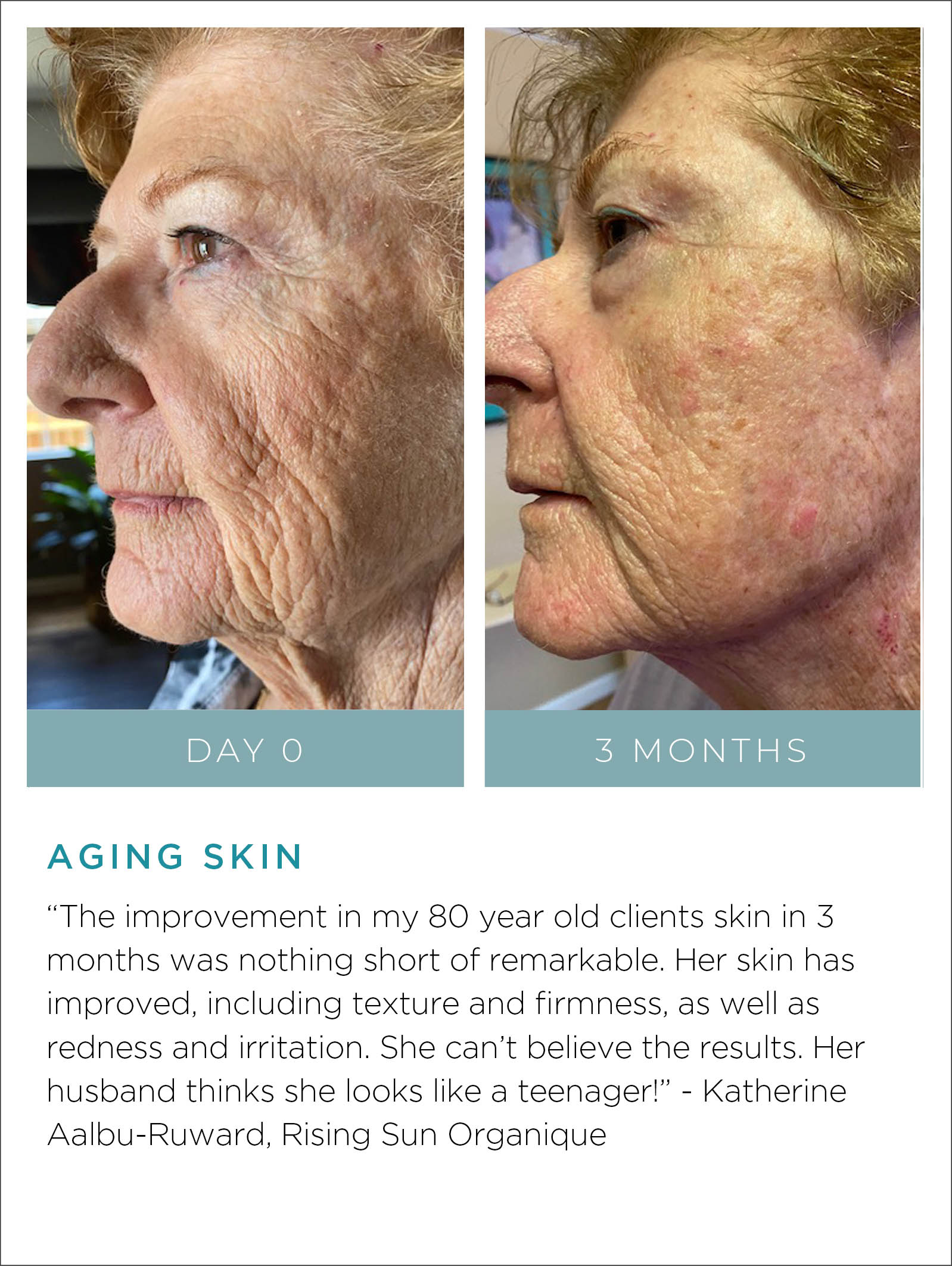 Aging Skin Before + After
