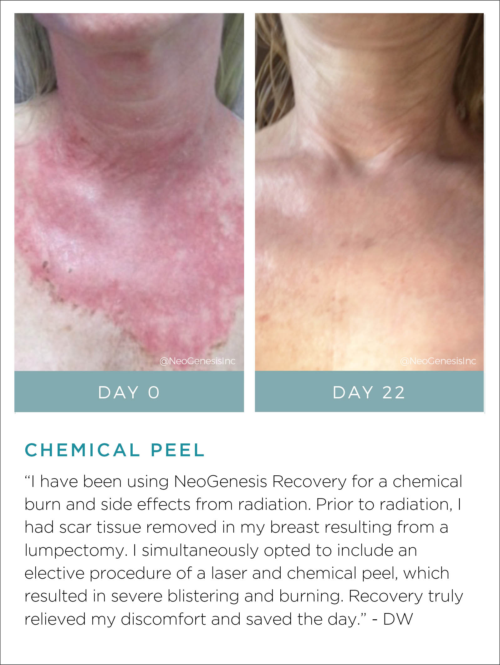 Chemical Peel Before + After