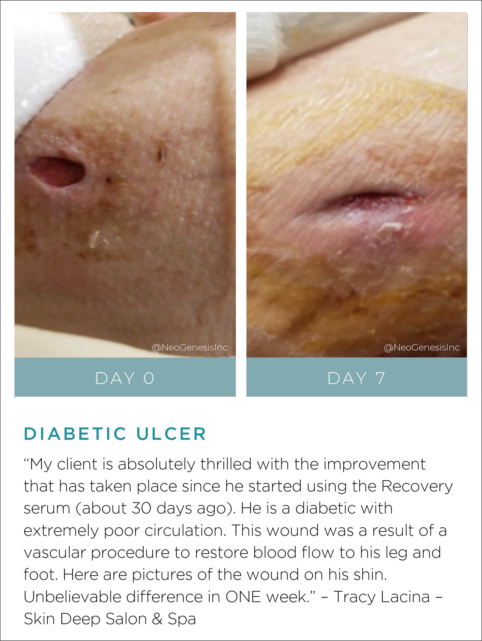 Diabetic Ulcer Before + After