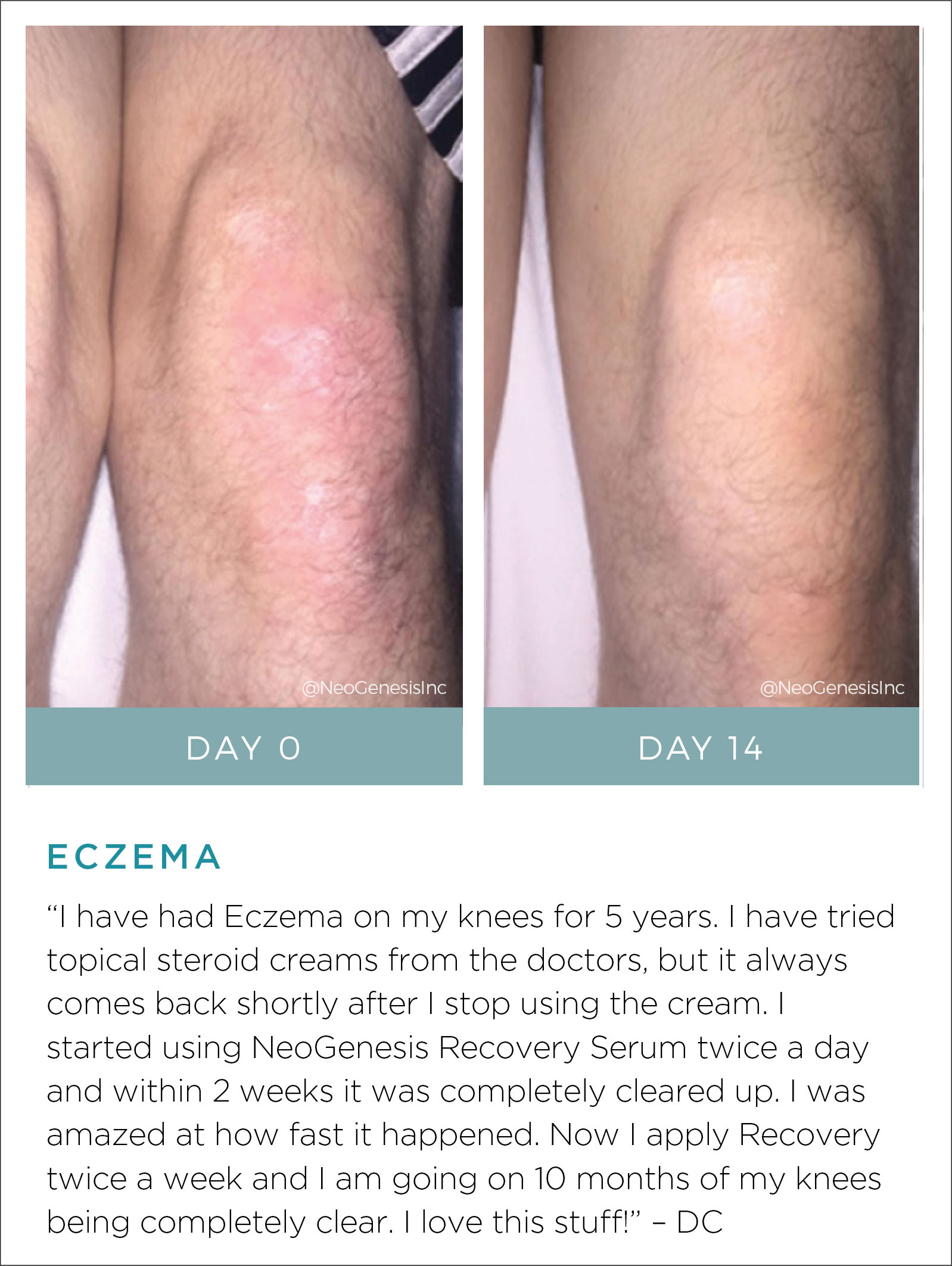 Eczema Before + After