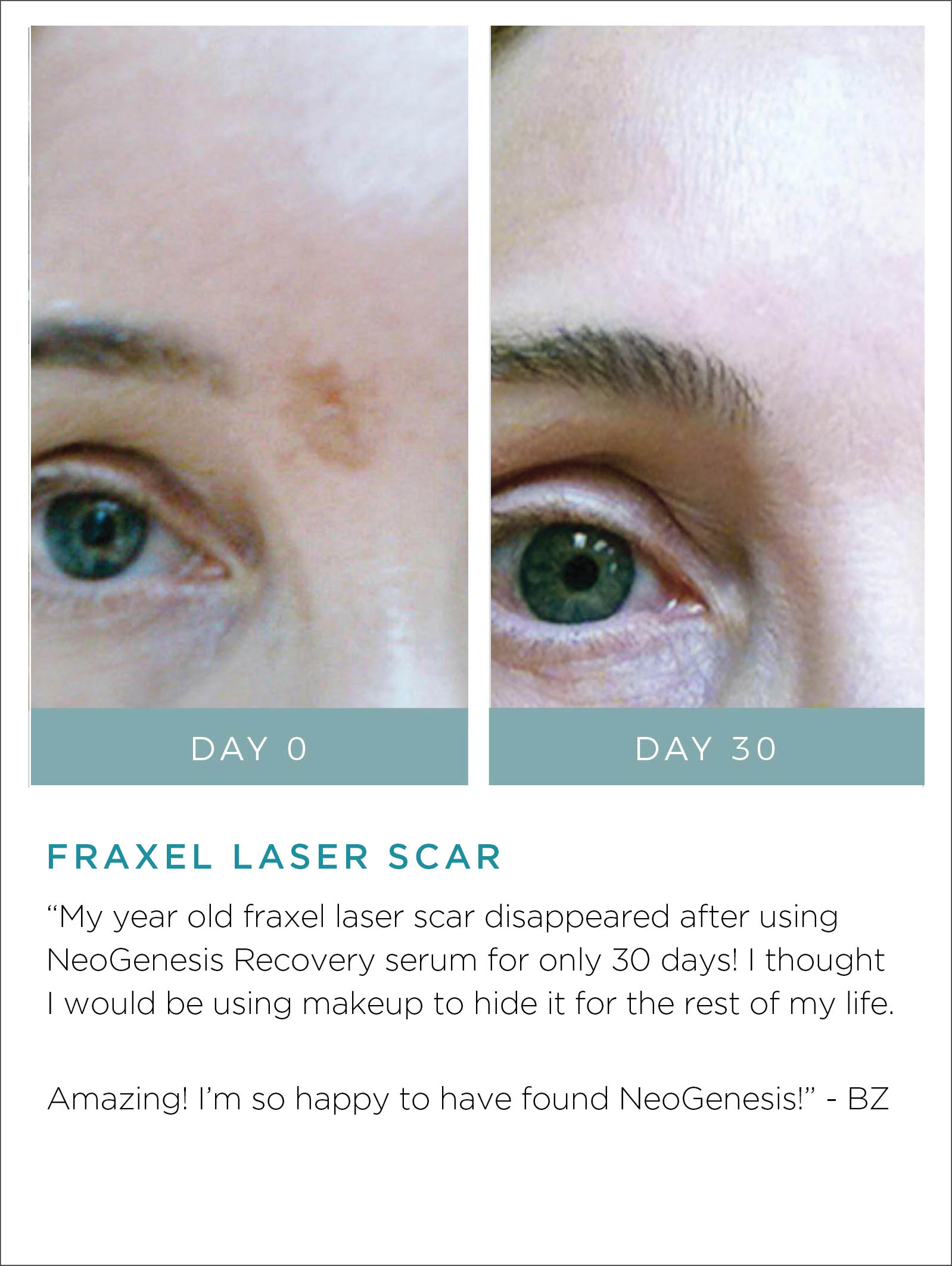 Fraxel Laser Scar Before + After