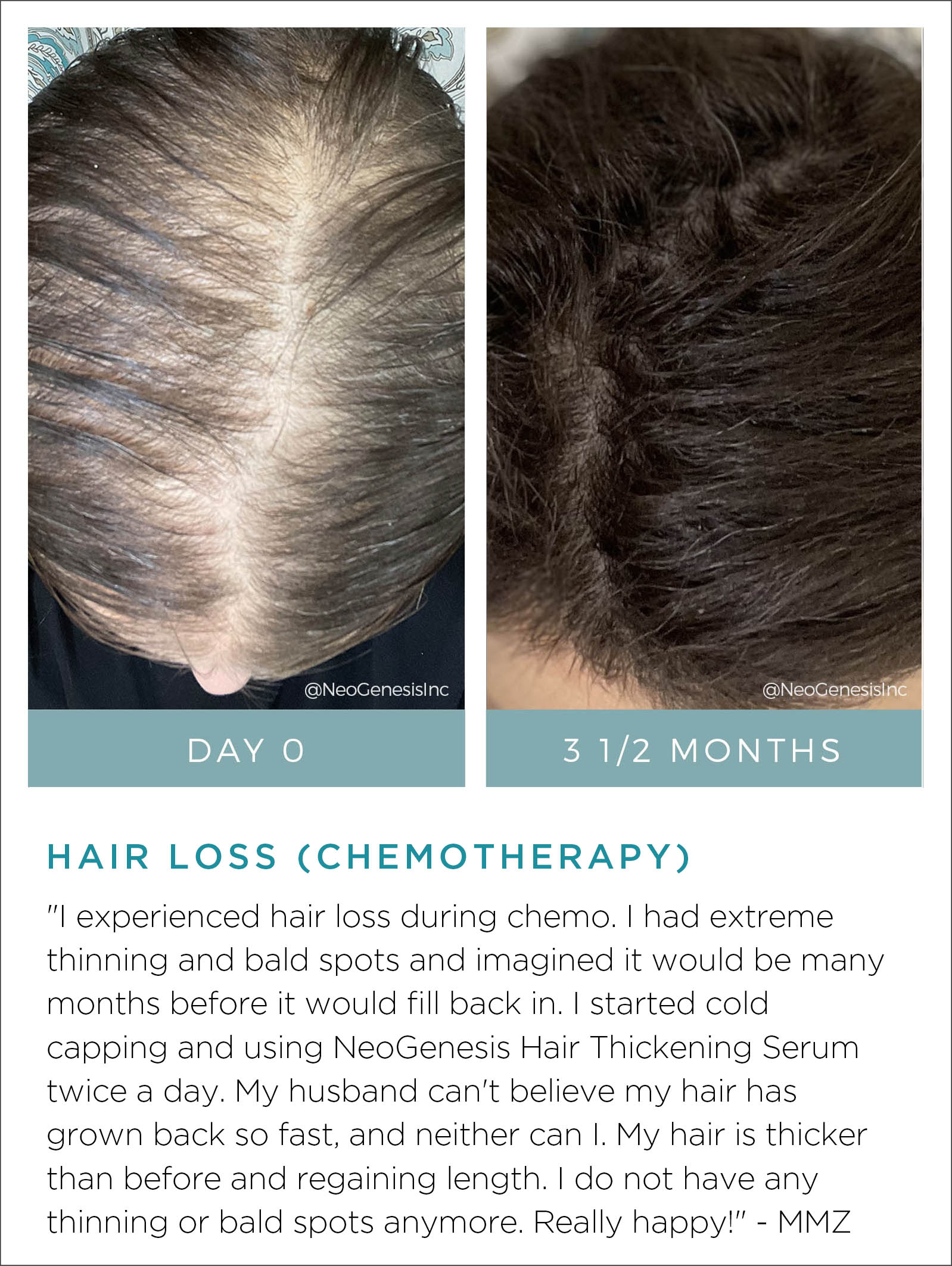 Chemotherapy Hair Loss Before + After
