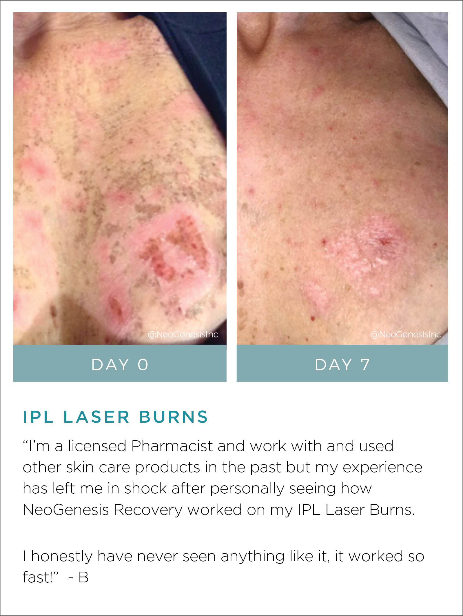 IPL Laser Burns Before + After