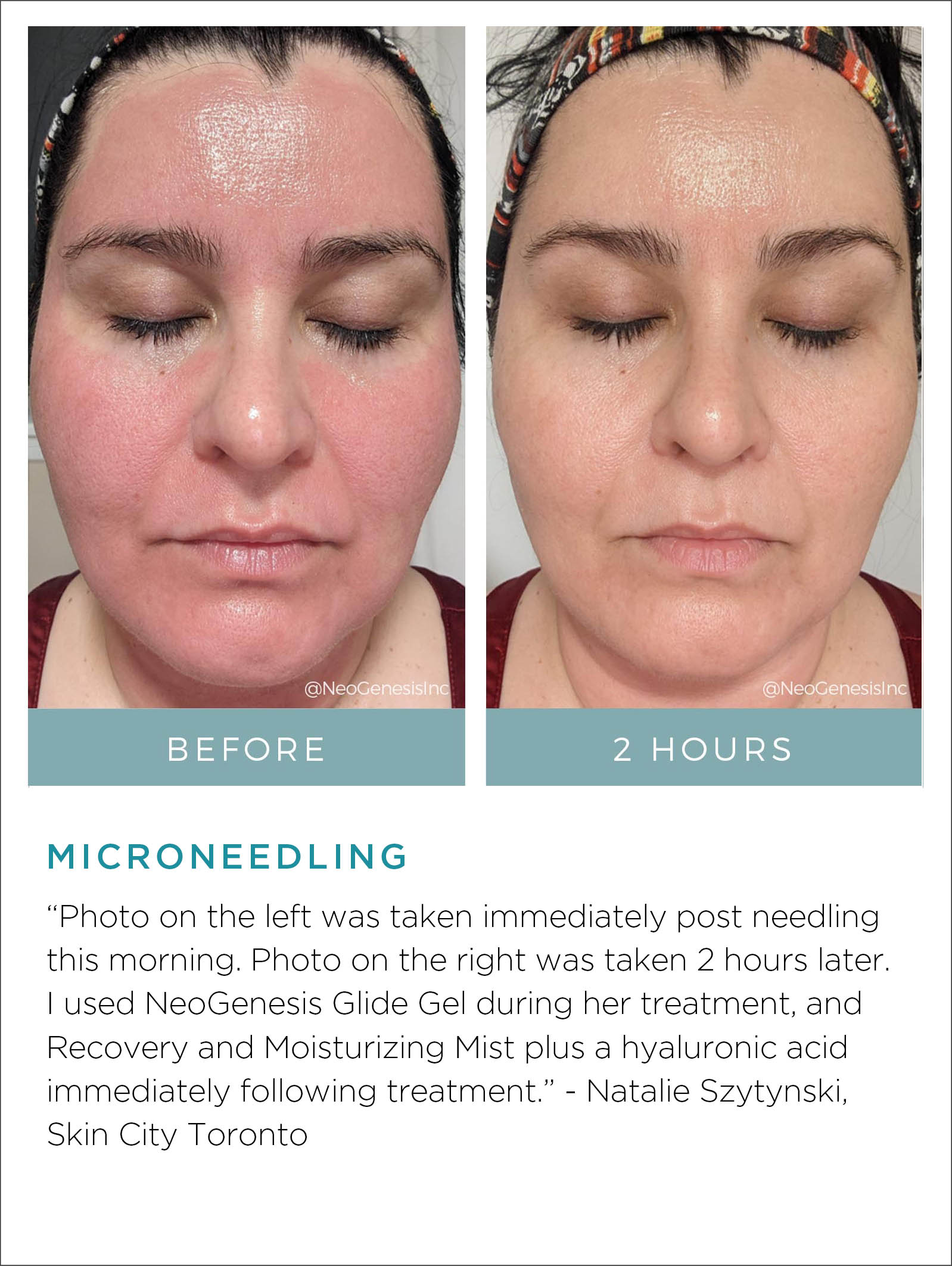 Microneedling Before + After