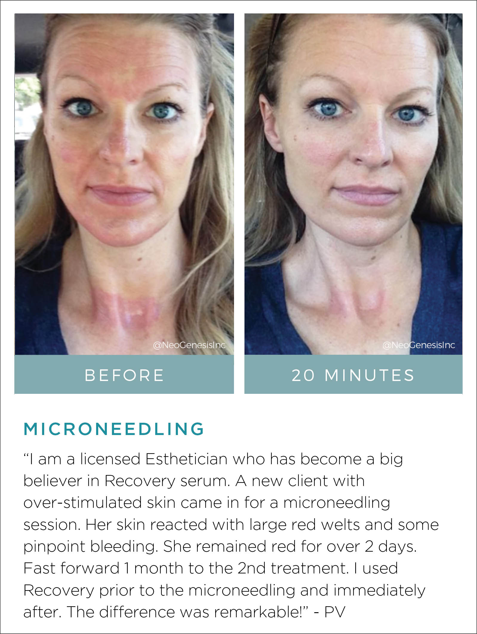 Microneedling Before + After
