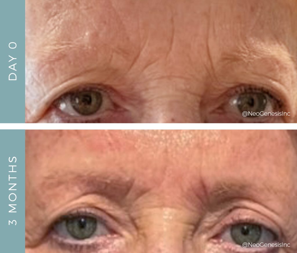 Before + After - Advanced Signs of Aging