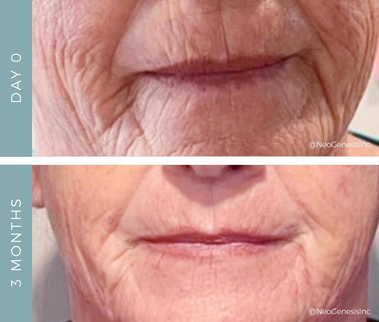 Before + After - Aging Mouth