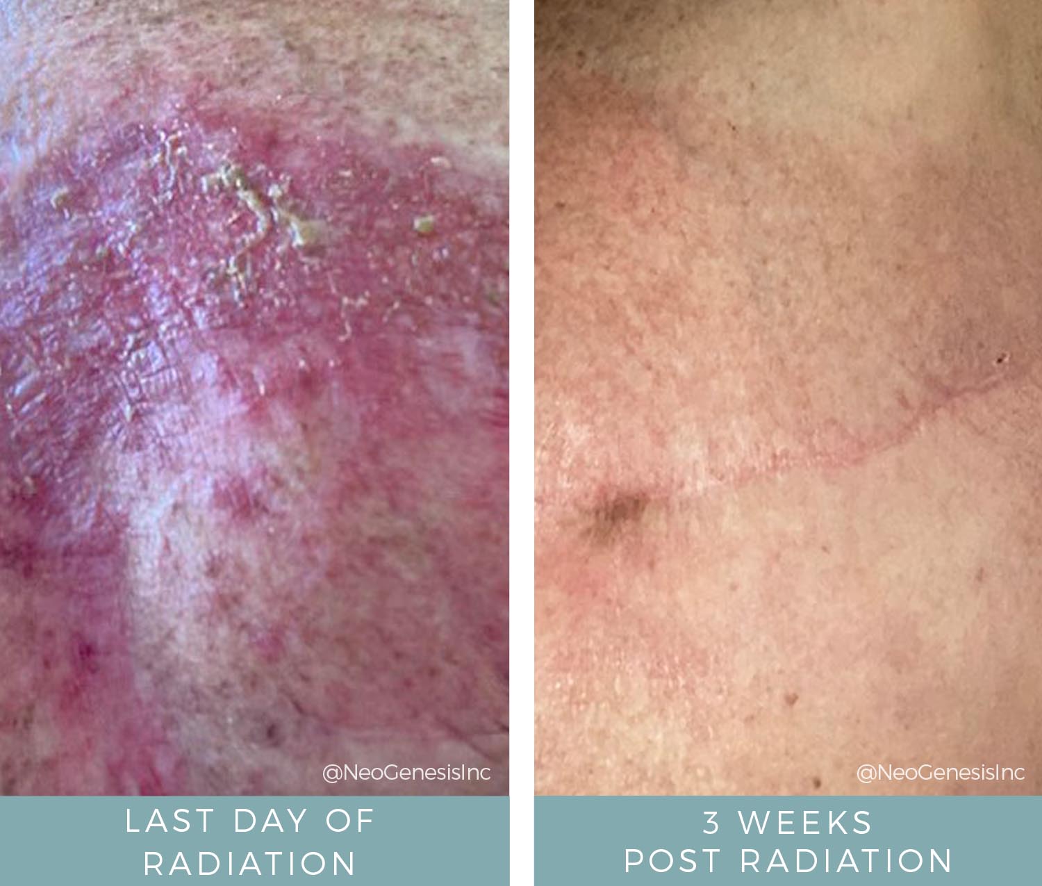 Before + After - Radiation for Follicular Non-Hodgkins Lymphoma