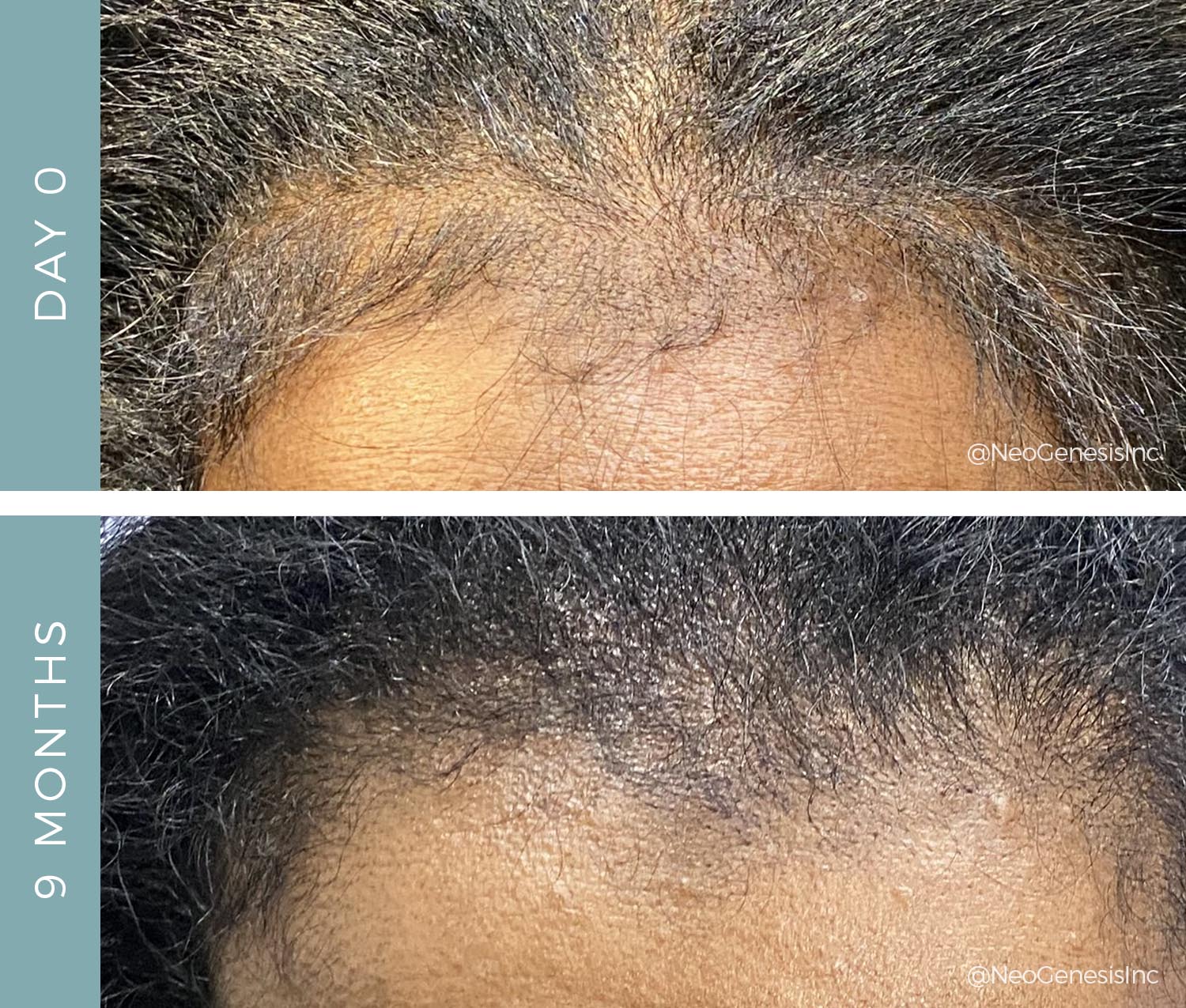 Hair Loss - Before + After Hair Thickening Serum