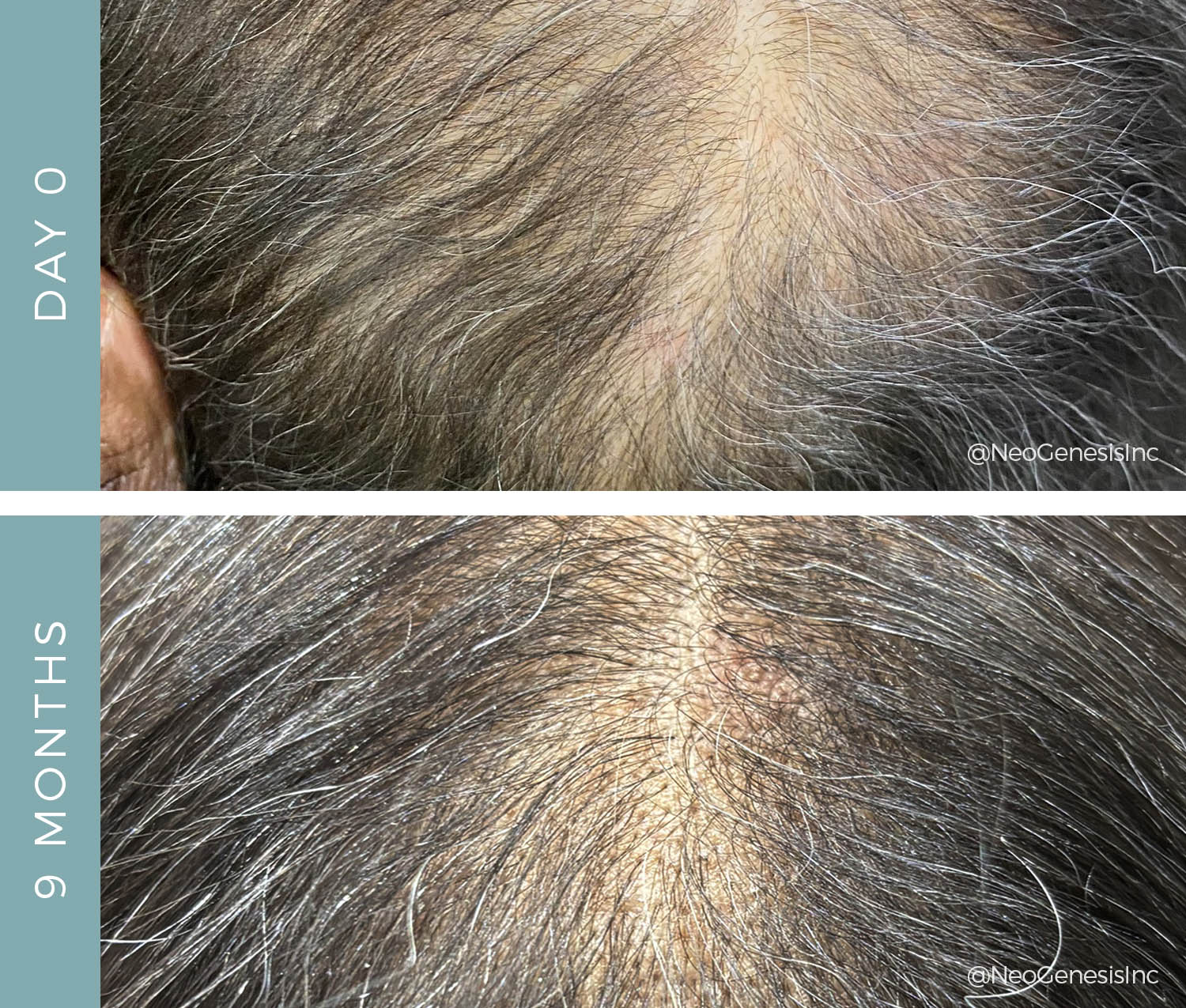Alopecia Areata + Androgenetic Alopeica - Before + After
