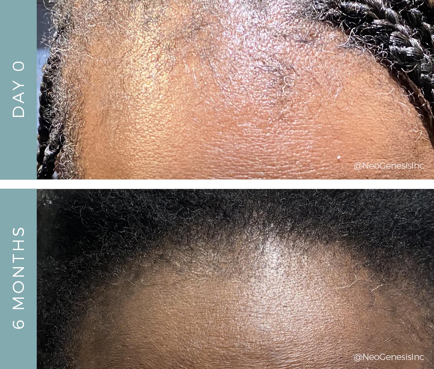 Traction Alopecia - Before + After NeoGenesis Hair Thickening Serum